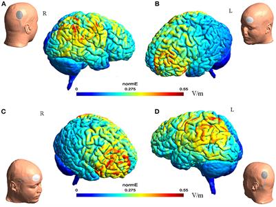 Transcranial Direct Current Stimulation for Patients With Pharmacoresistant Epileptic Spasms: A Pilot Study